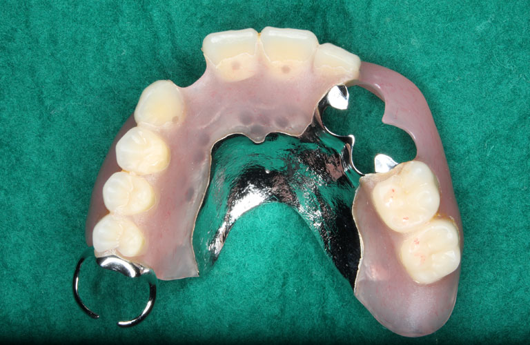 エステショット症例3 製作したエステショット義歯