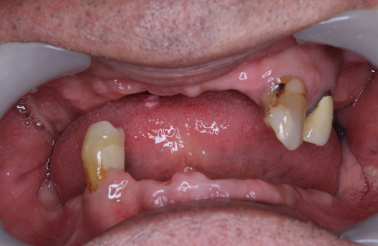 コーヌス義歯症例1 治療前