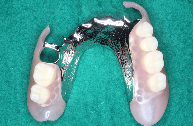 エステショット症例1　製作したエステショット義歯 下顎