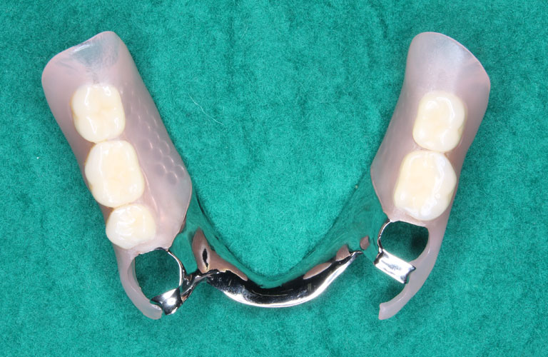 エステショット症例1　製作したエステショット義歯 上顎